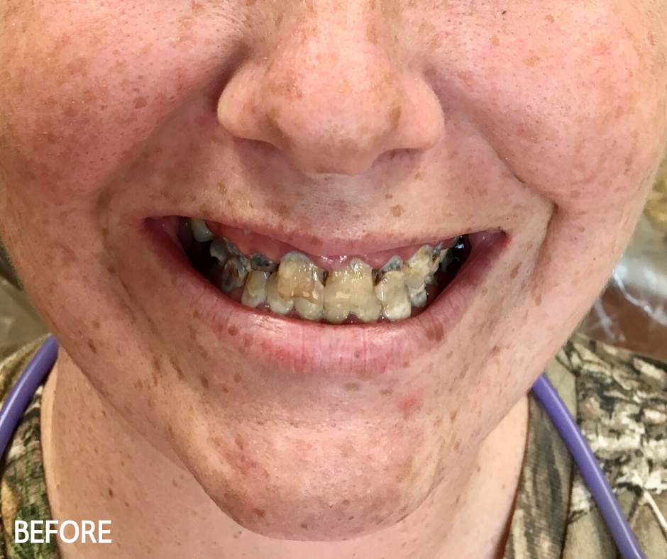 Snap in Dentures Custom Dental of Atoka Atoka OK